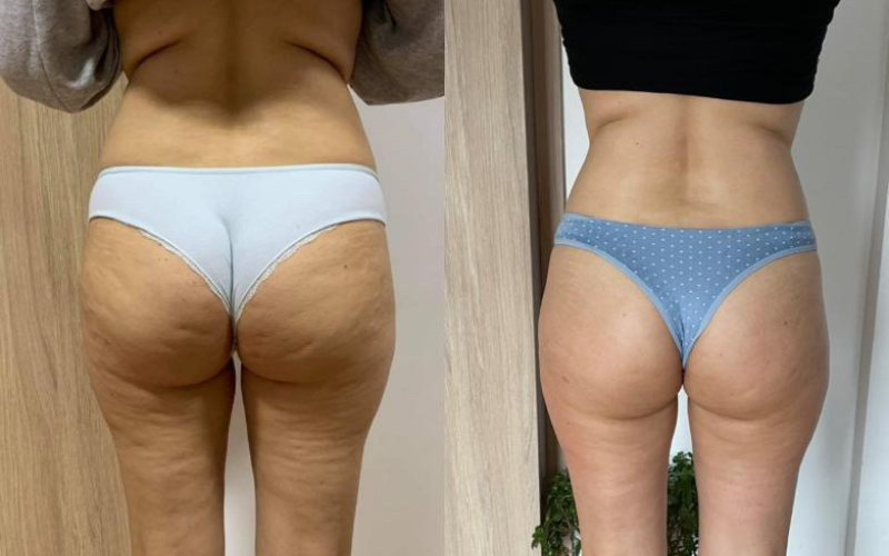 before-after