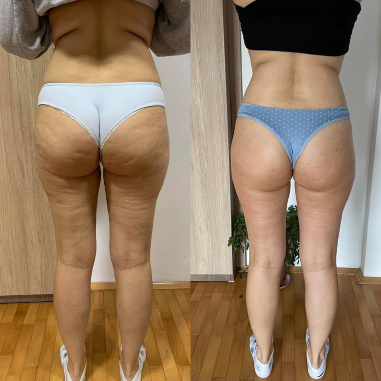 before-after